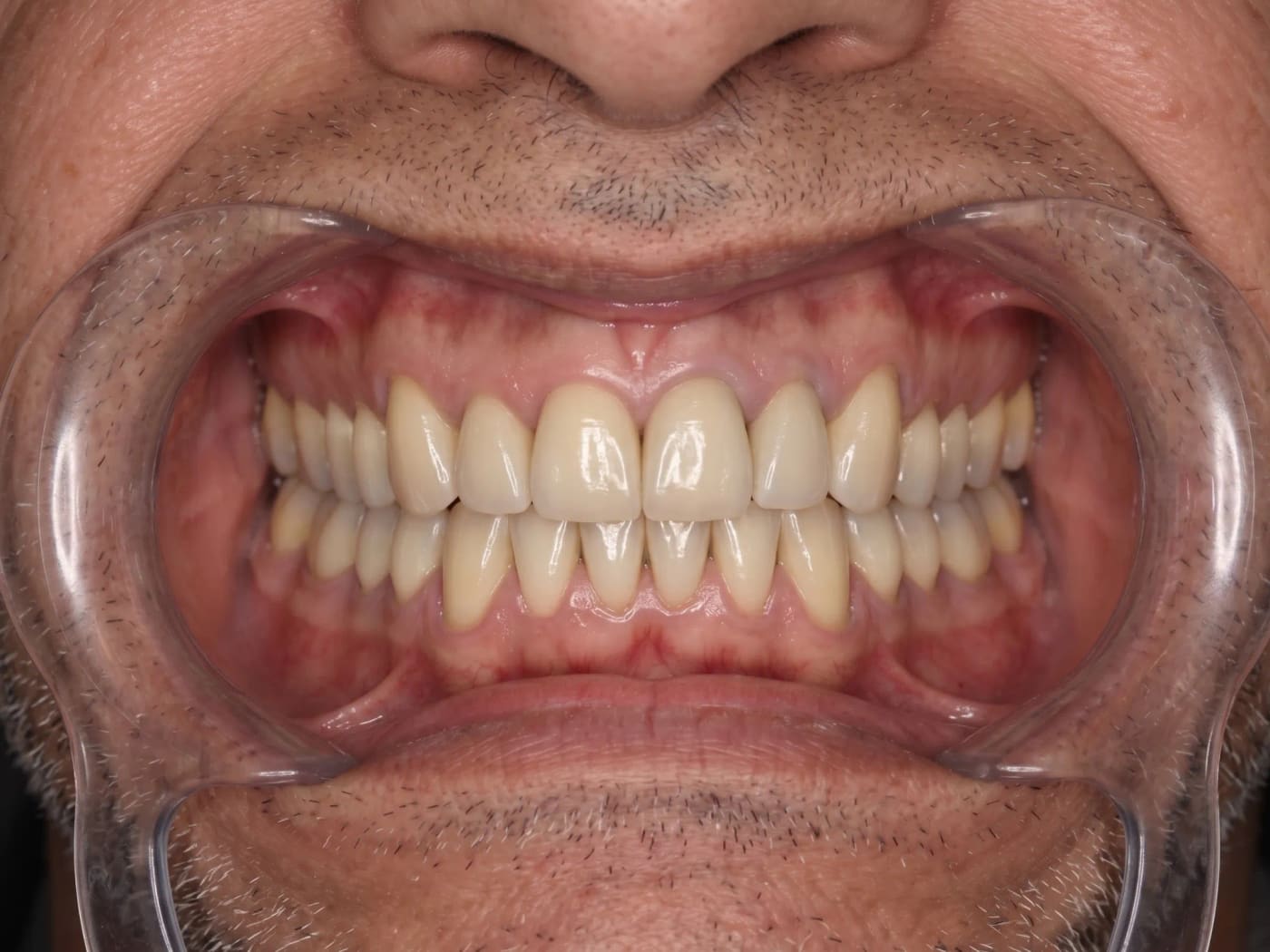 Case 011, After