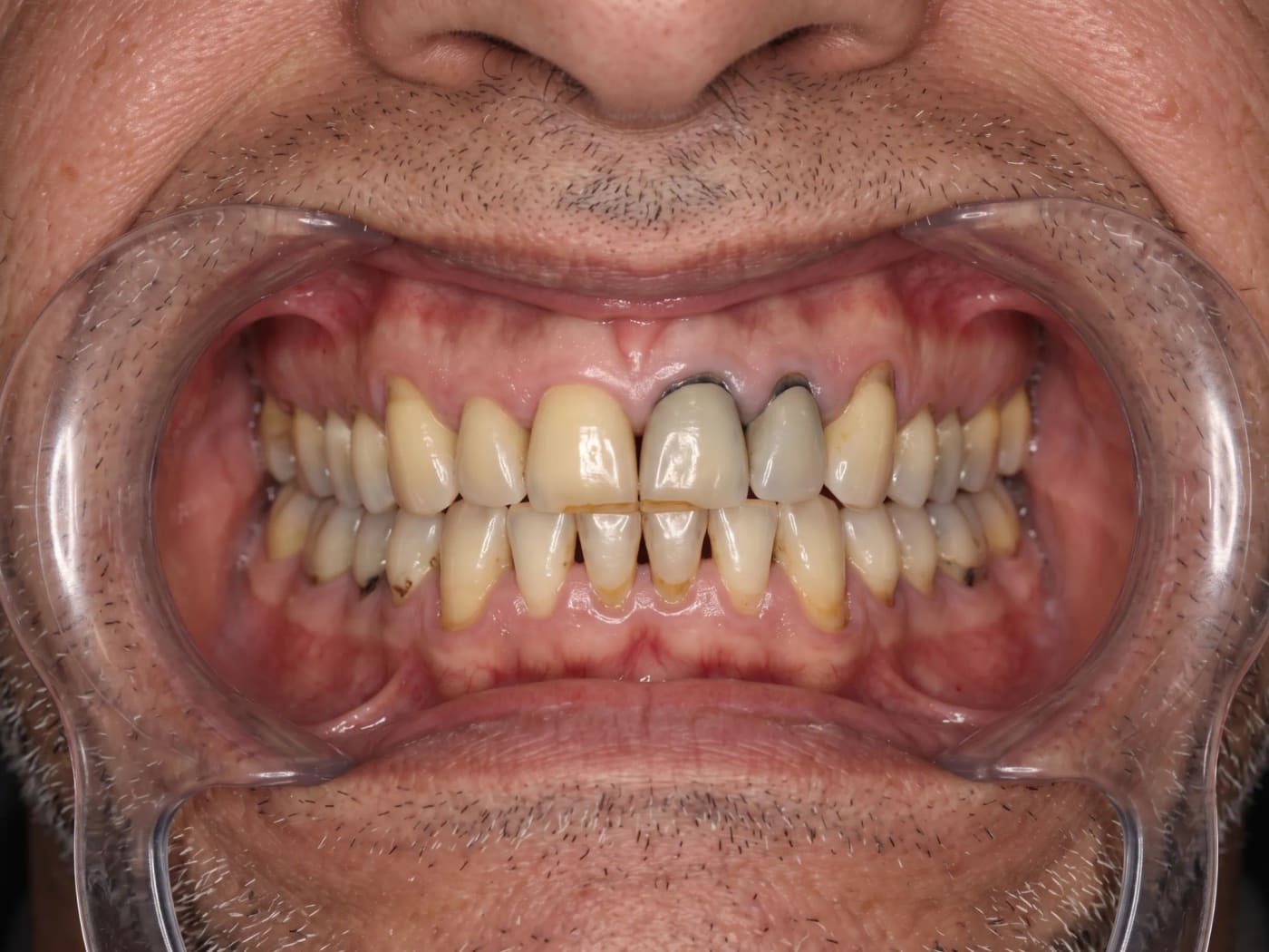 Case 011, Before