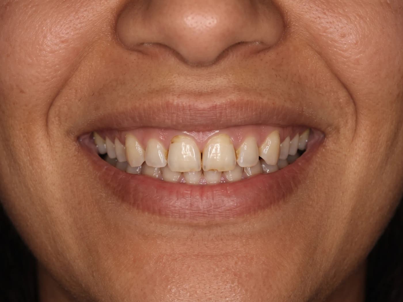 Case 014 before treatment