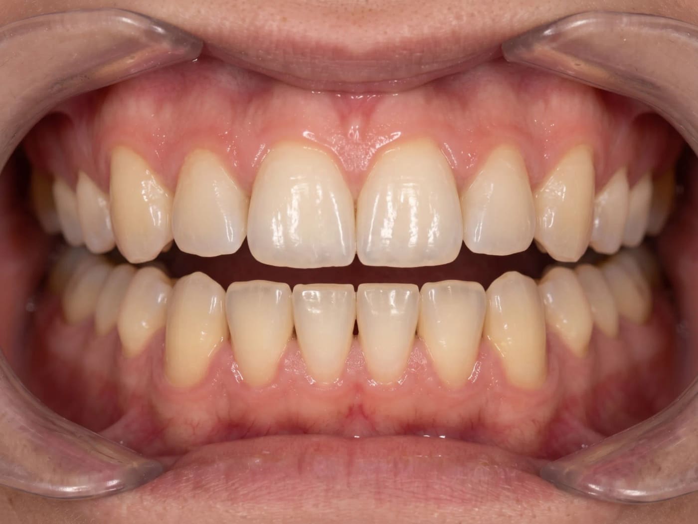 Case 017, After