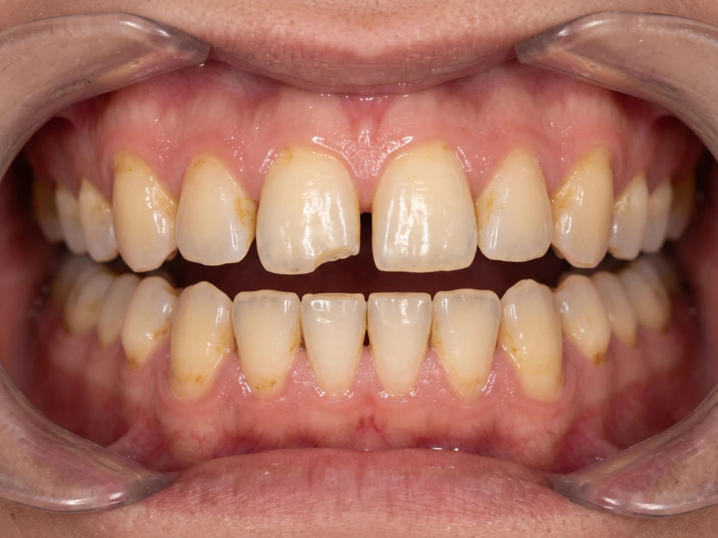 Case 017, Before