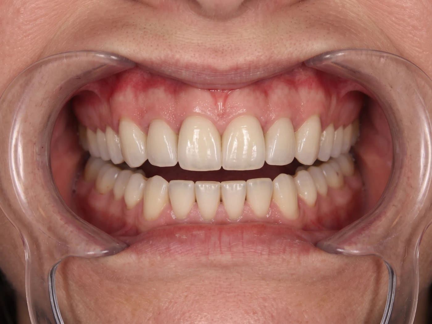 Case 021, After