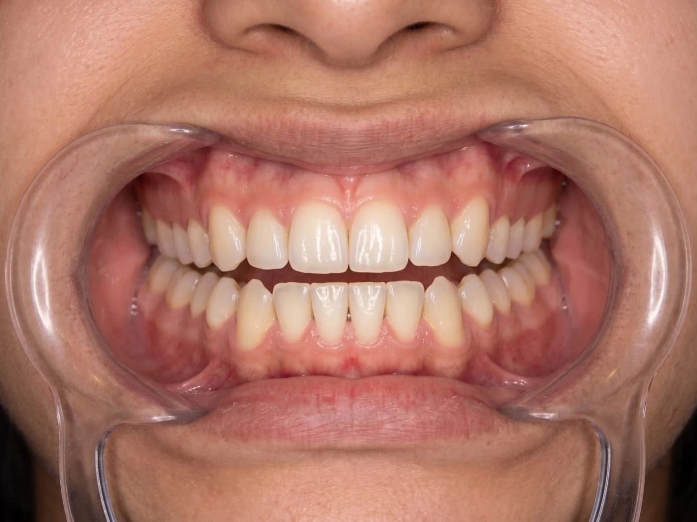 Case 023, After