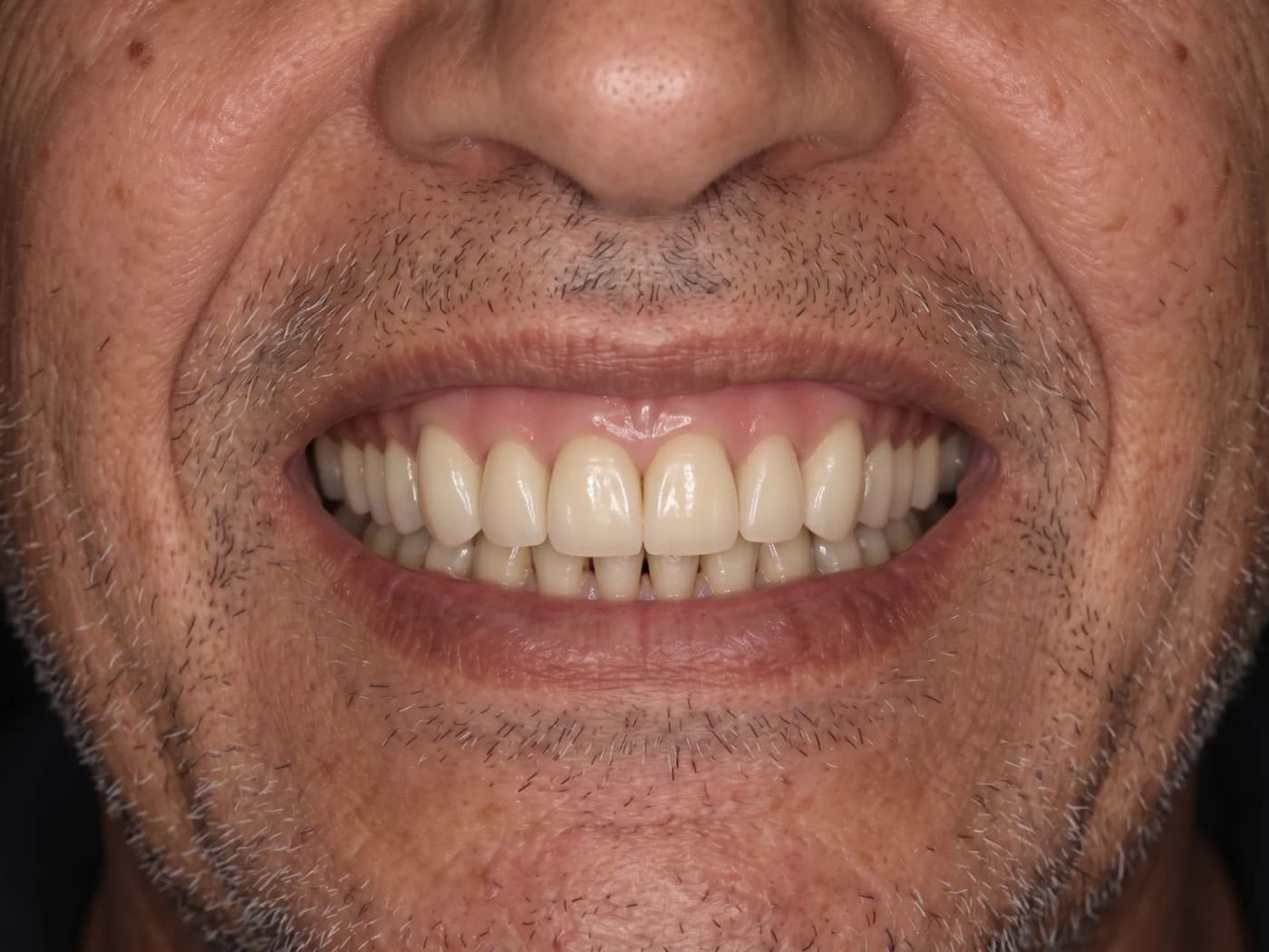 Case 026, After