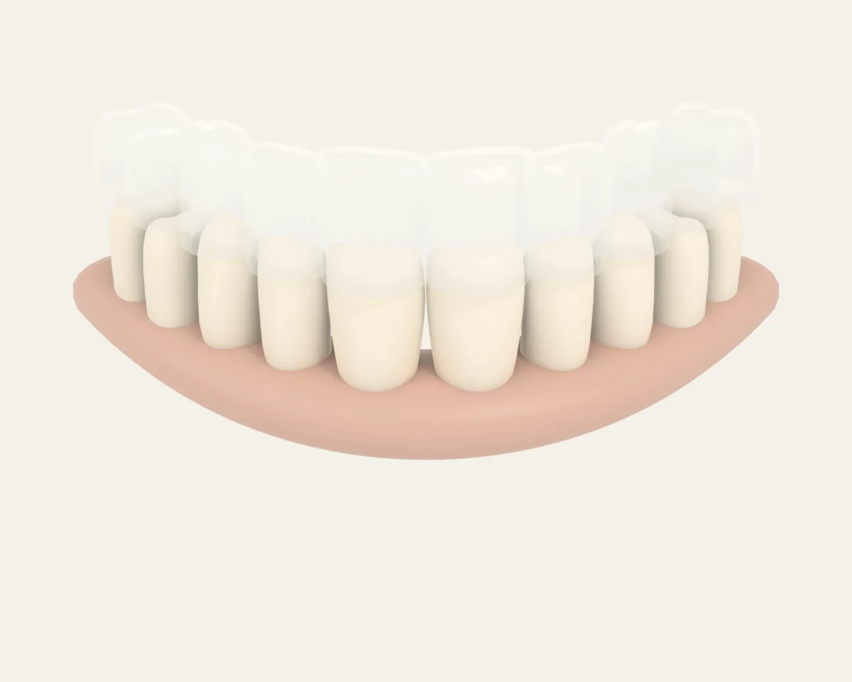 Illustration poster for Clear aligners